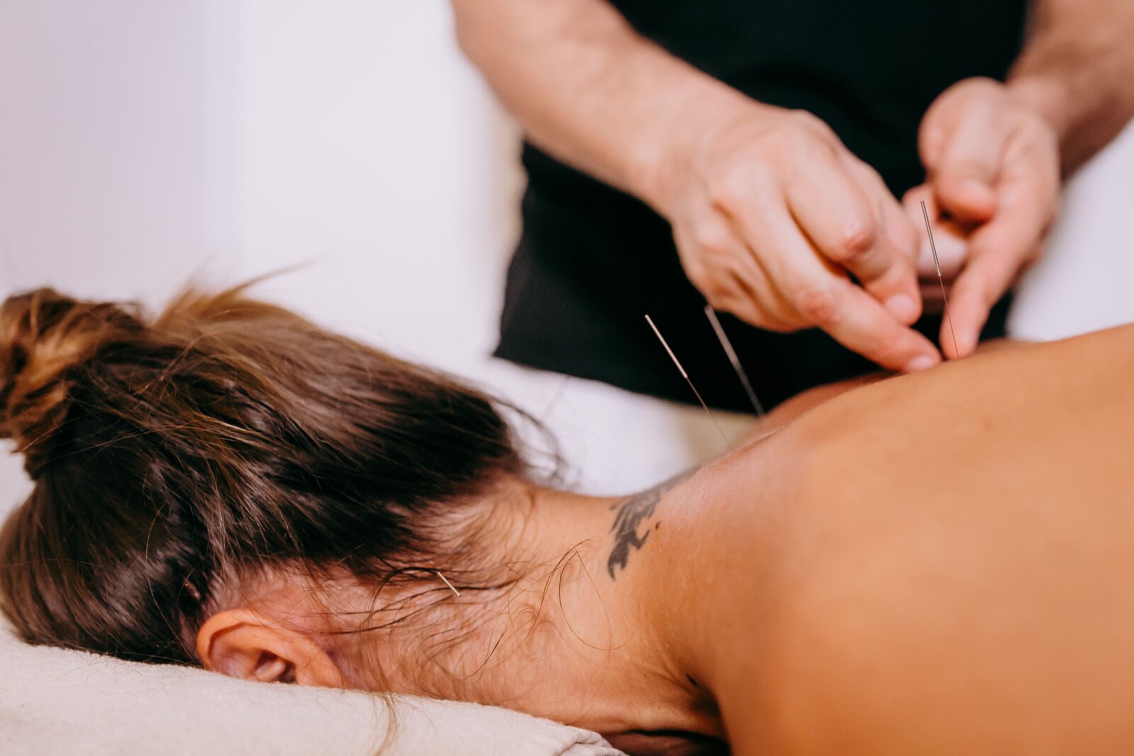 A practitioner placing fine acupuncture needles in a client's upper back